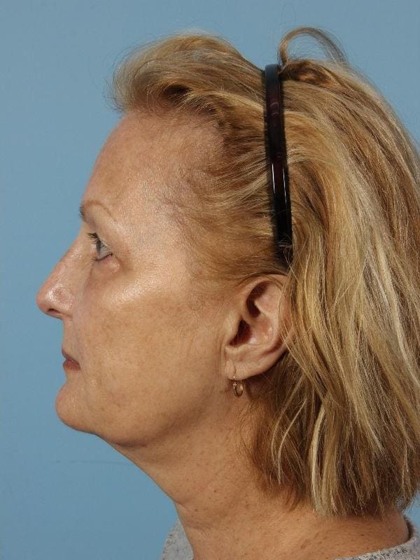 Laser Skin Treatments Patient Photo - Case 16185 - after view-1