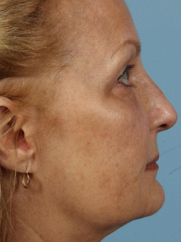 Laser Skin Treatments Patient Photo - Case 16185 - after view-4