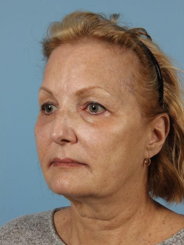 Laser Skin Treatments Patient Photo - Case 16185 - after view-5