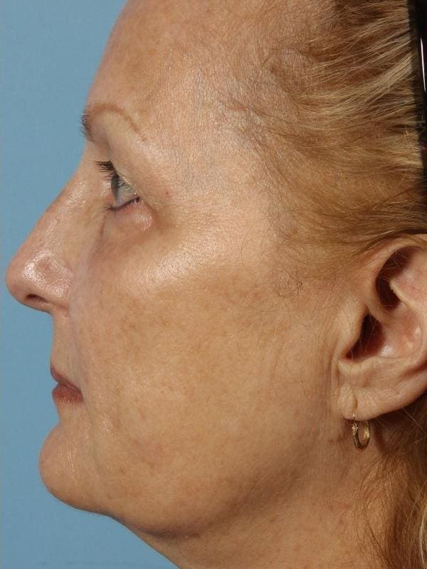 Laser Skin Treatments Patient Photo - Case 16185 - after view-2