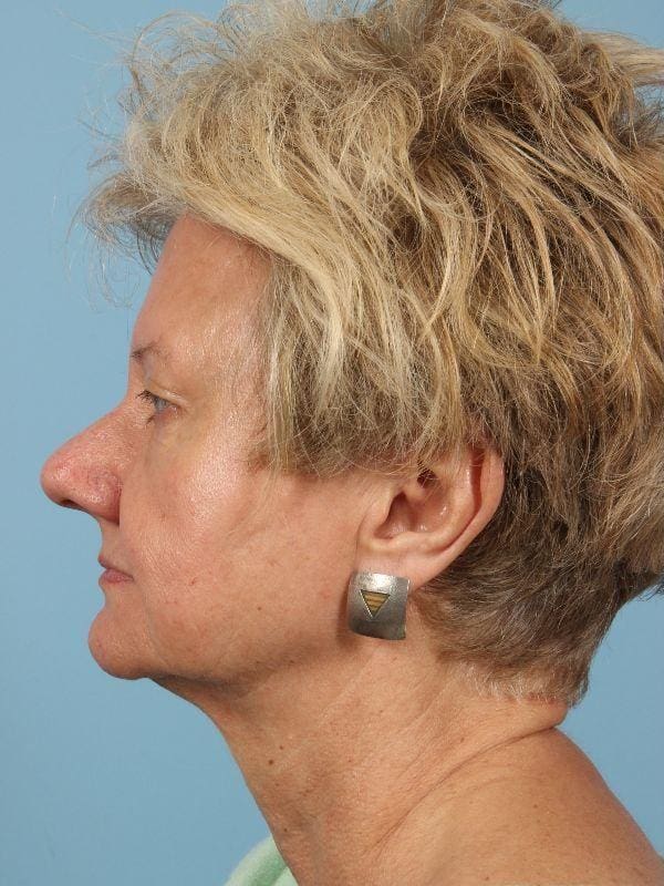 Laser Skin Treatments Patient Photo - Case 16203 - before view-1
