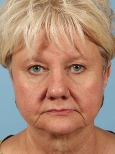 Laser Skin Treatments - Case 16203 - Before