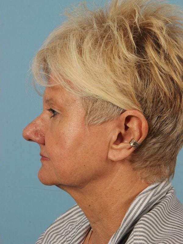 Laser Skin Treatments Patient Photo - Case 16203 - after view-1