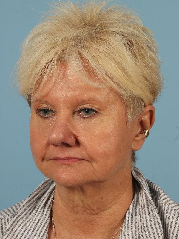 Laser Skin Treatments Patient Photo - Case 16203 - after view-2