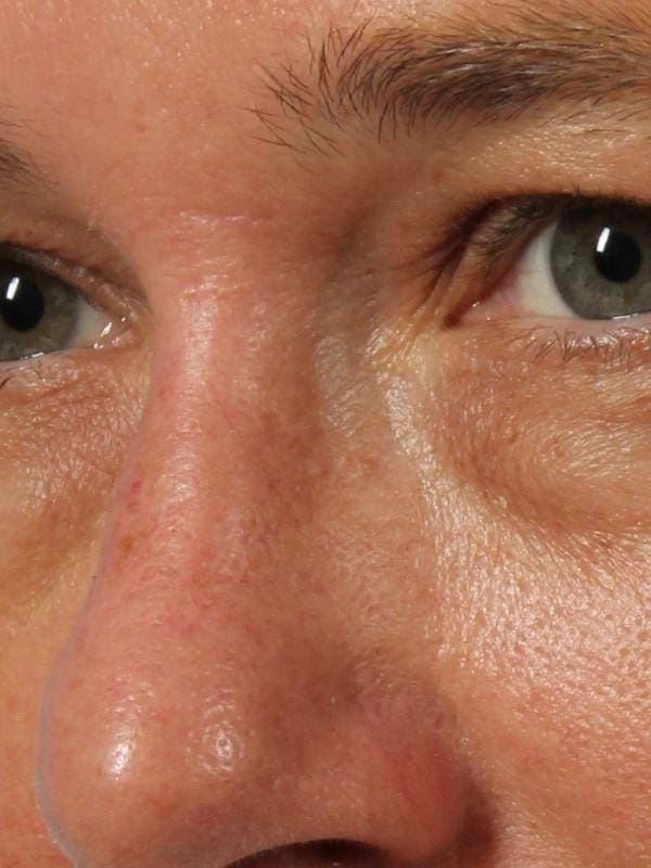 Laser Skin Treatments Patient Photo - Case 16213 - after view-1
