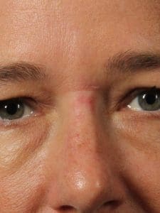 Laser Skin Treatments - Case 16213 - Before