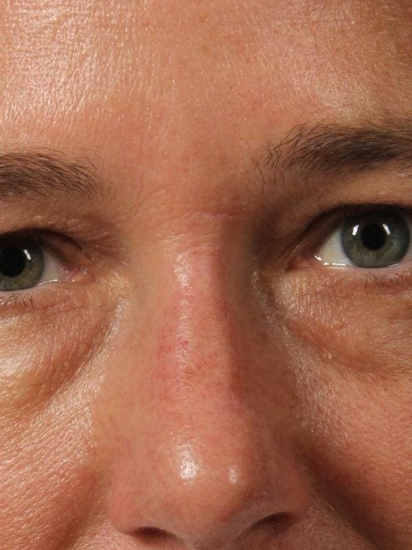 Laser Skin Treatments Patient Photo - Case 16213 - after view