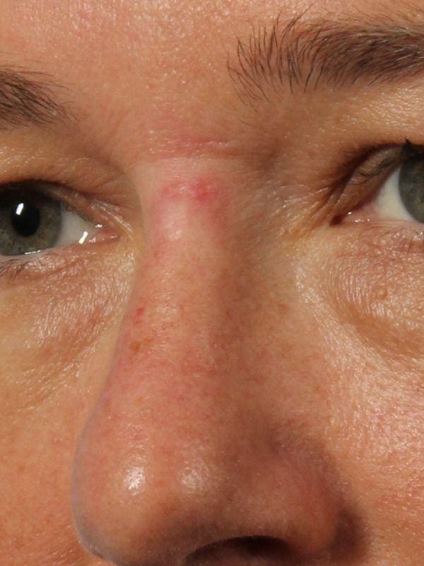 Laser Skin Treatments Patient Photo - Case 16213 - before view-1