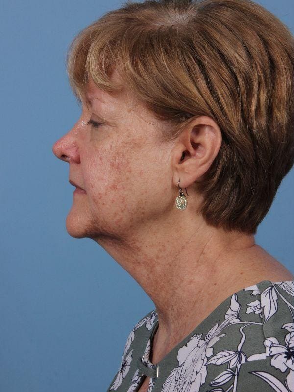 Laser Skin Treatments Patient Photo - Case 16232 - before view-1