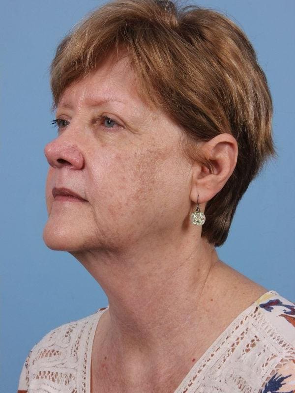 Laser Skin Treatments Patient Photo - Case 16232 - after view-3