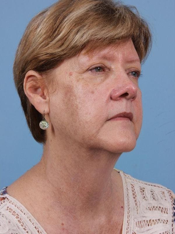 Laser Skin Treatments Patient Photo - Case 16232 - after view-4