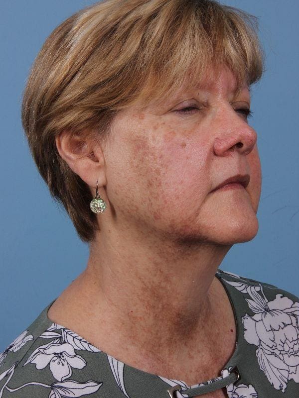 Laser Skin Treatments Patient Photo - Case 16232 - before view-4