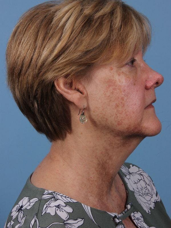 Laser Skin Treatments Patient Photo - Case 16232 - before view-2