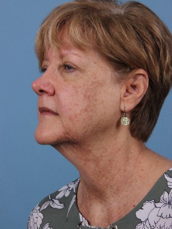 Laser Skin Treatments Patient Photo - Case 16232 - before view-3