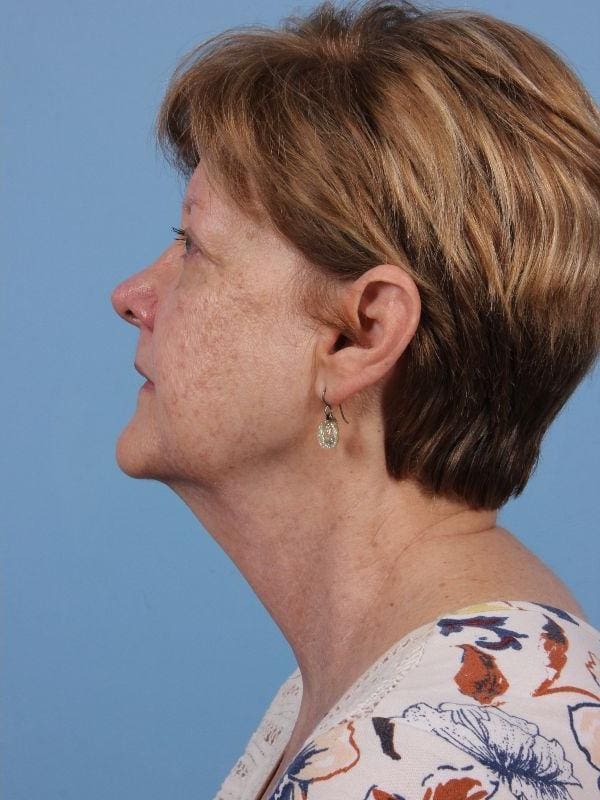 Laser Skin Treatments Patient Photo - Case 16232 - after view-1