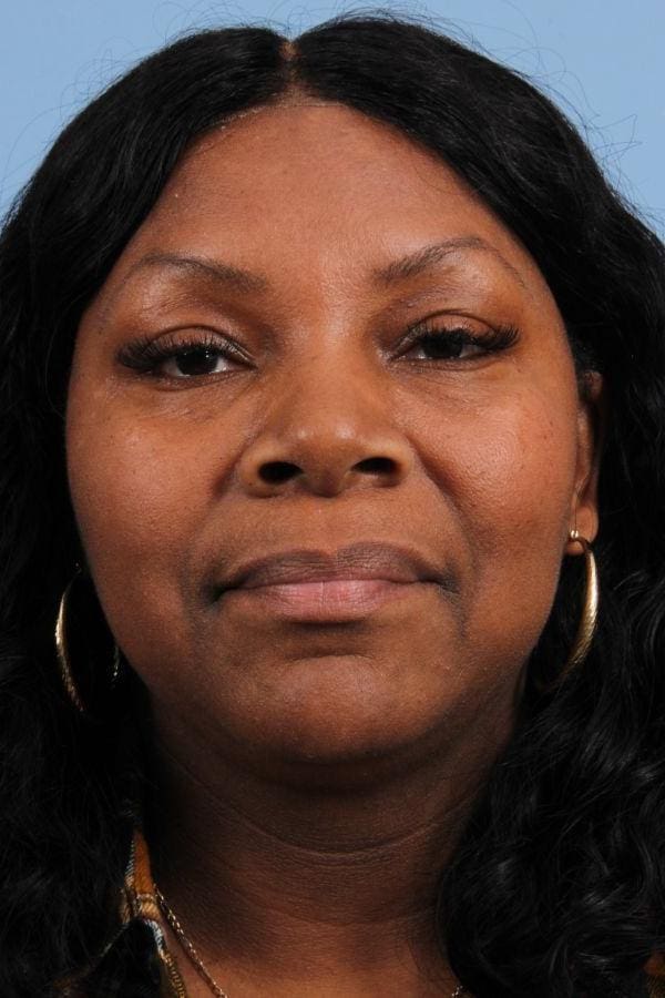 Laser Skin Treatments Patient Photo - Case 16244 - after view