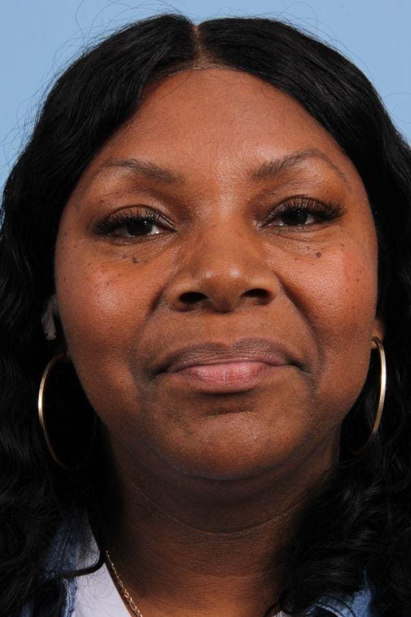 Laser Skin Treatments Patient Photo - Case 16244 - before view-