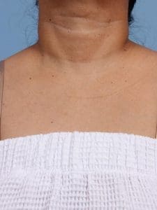 Laser Skin Treatments - Case 16252 - Before