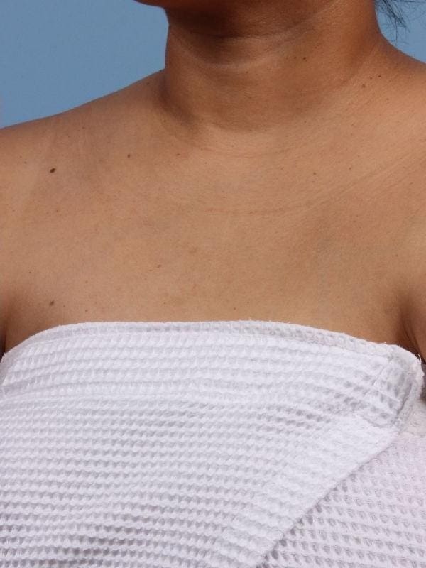 Laser Skin Treatments Patient Photo - Case 16252 - after view-1