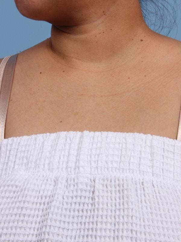 Laser Skin Treatments Patient Photo - Case 16252 - before view-1