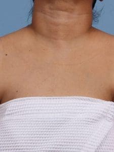 Laser Skin Treatments - Case 16252 - After