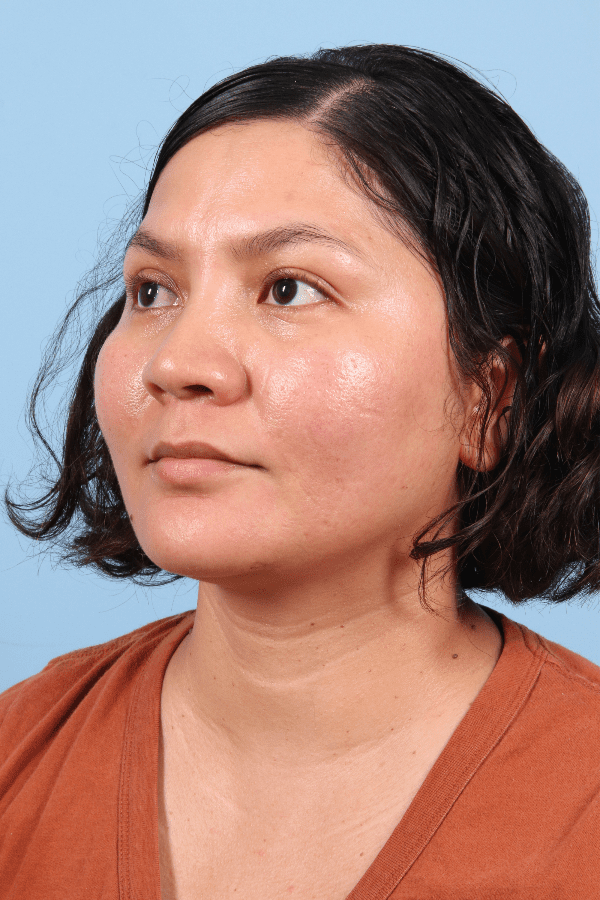 Laser Skin Treatments Patient Photo - Case 16259 - after view-3