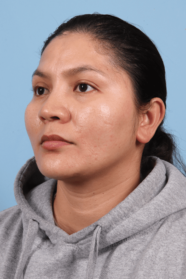 Laser Skin Treatments Patient Photo - Case 16259 - before view-3