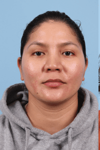 Laser Skin Treatments - Case 16259 - Before