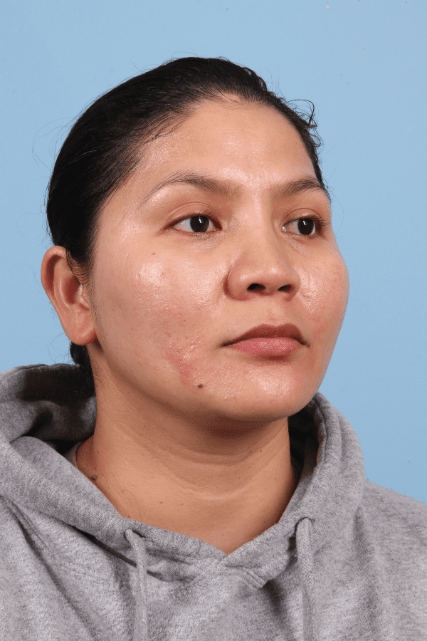 Laser Skin Treatments Patient Photo - Case 16259 - before view-4