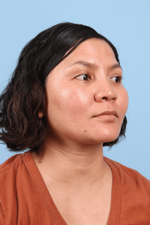 Laser Skin Treatments Patient Photo - Case 16259 - after view-4