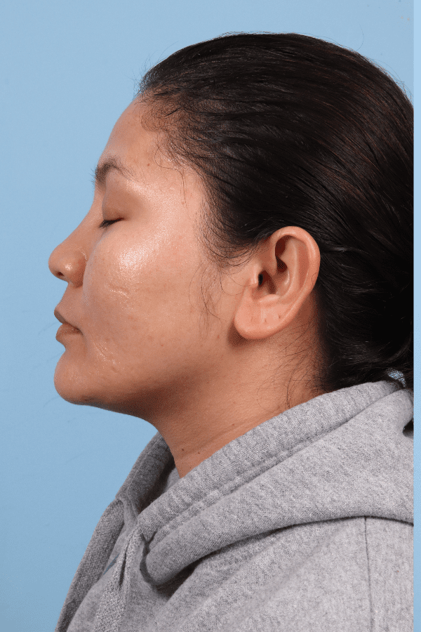 Laser Skin Treatments Patient Photo - Case 16259 - before view-1