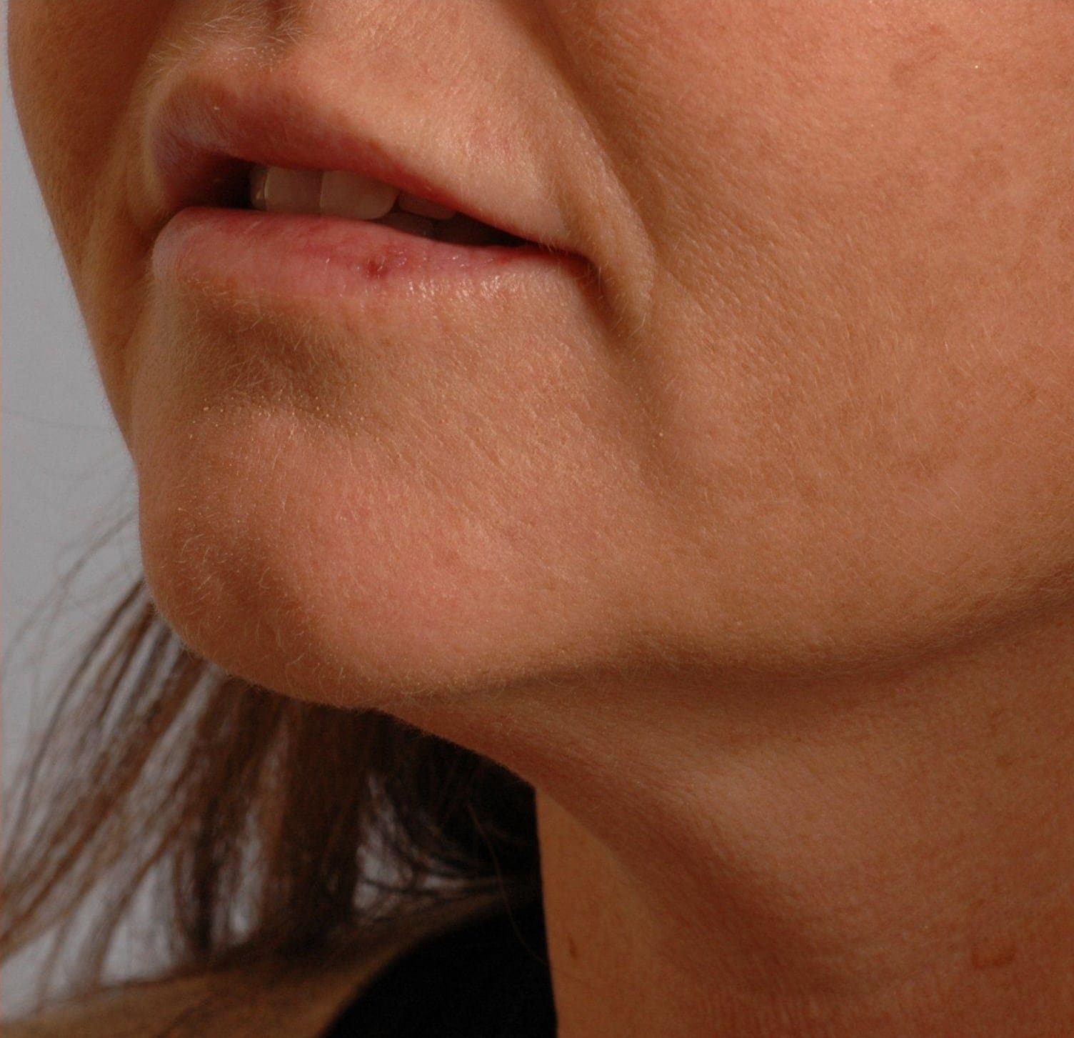 Lip Augmentation Patient Photo - Case 16271 - after view-2
