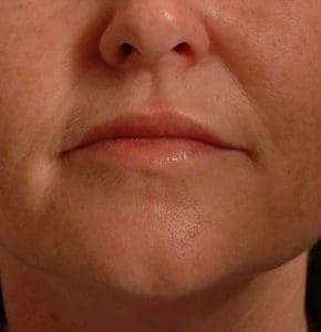 Lip Augmentation - Case 16271 - After