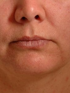 Lip Augmentation - Case 16279 - Before