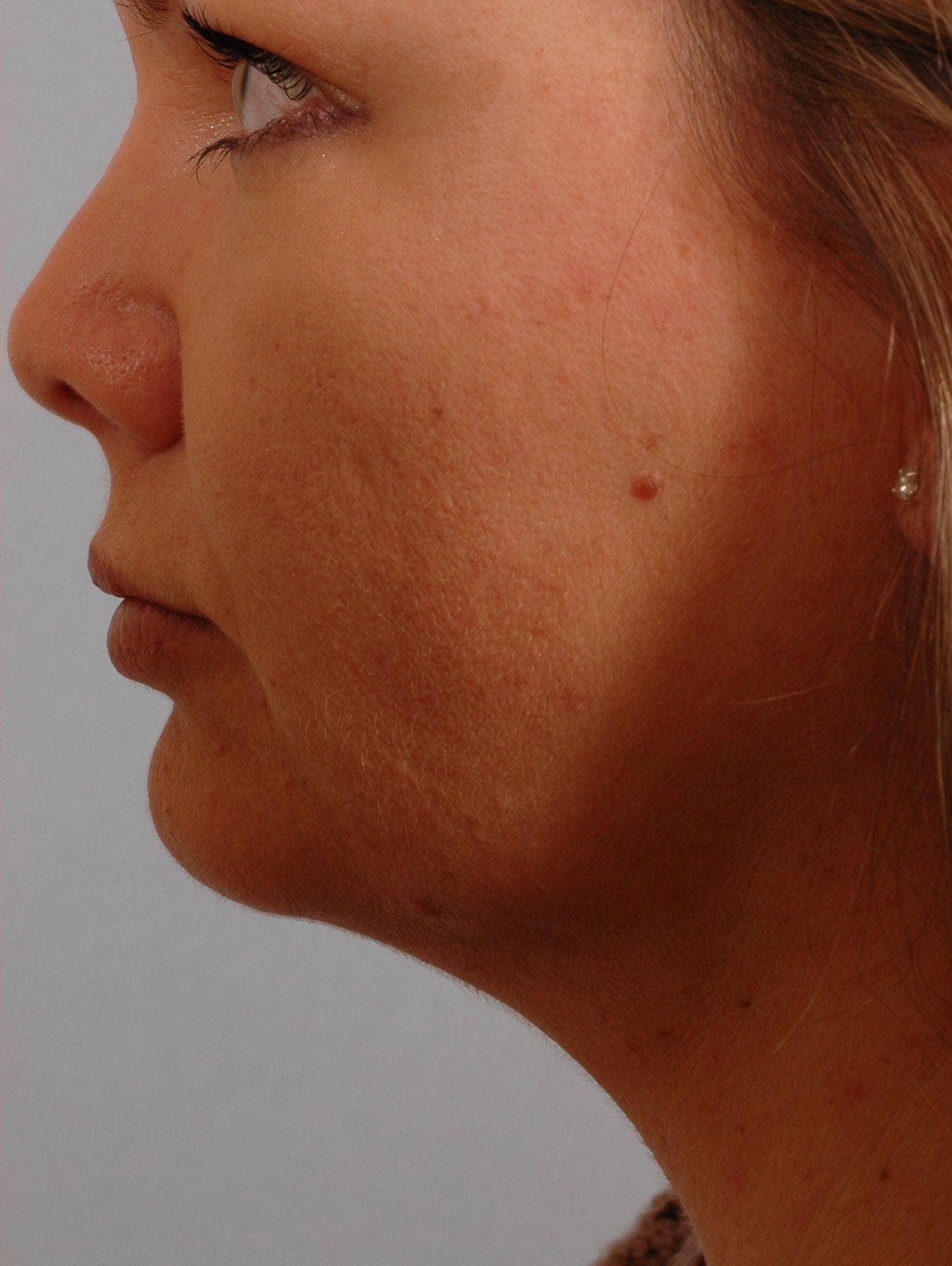 Lip Augmentation Patient Photo - Case 16279 - after view-1