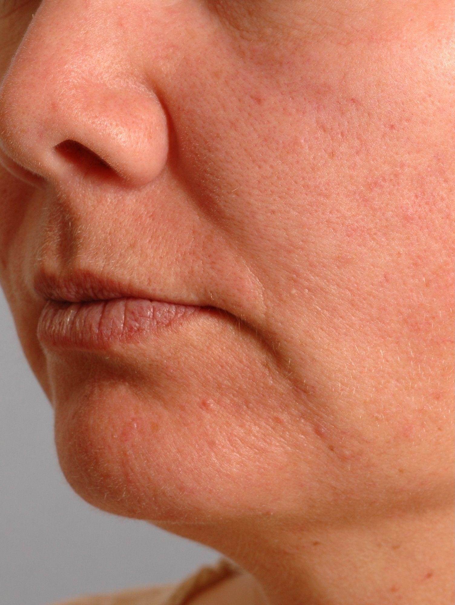 Lip Augmentation Patient Photo - Case 16279 - before view-2