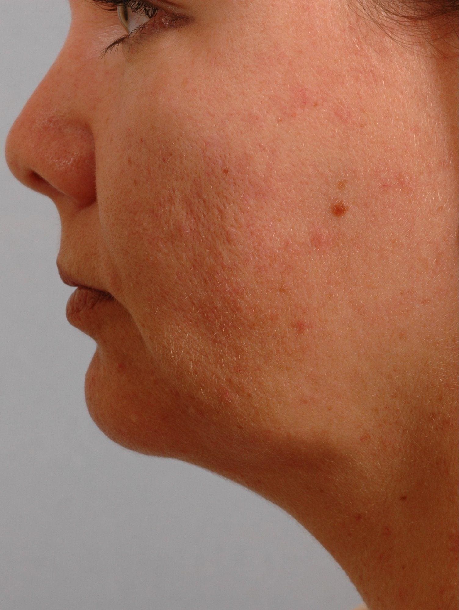 Lip Augmentation Patient Photo - Case 16279 - before view-1