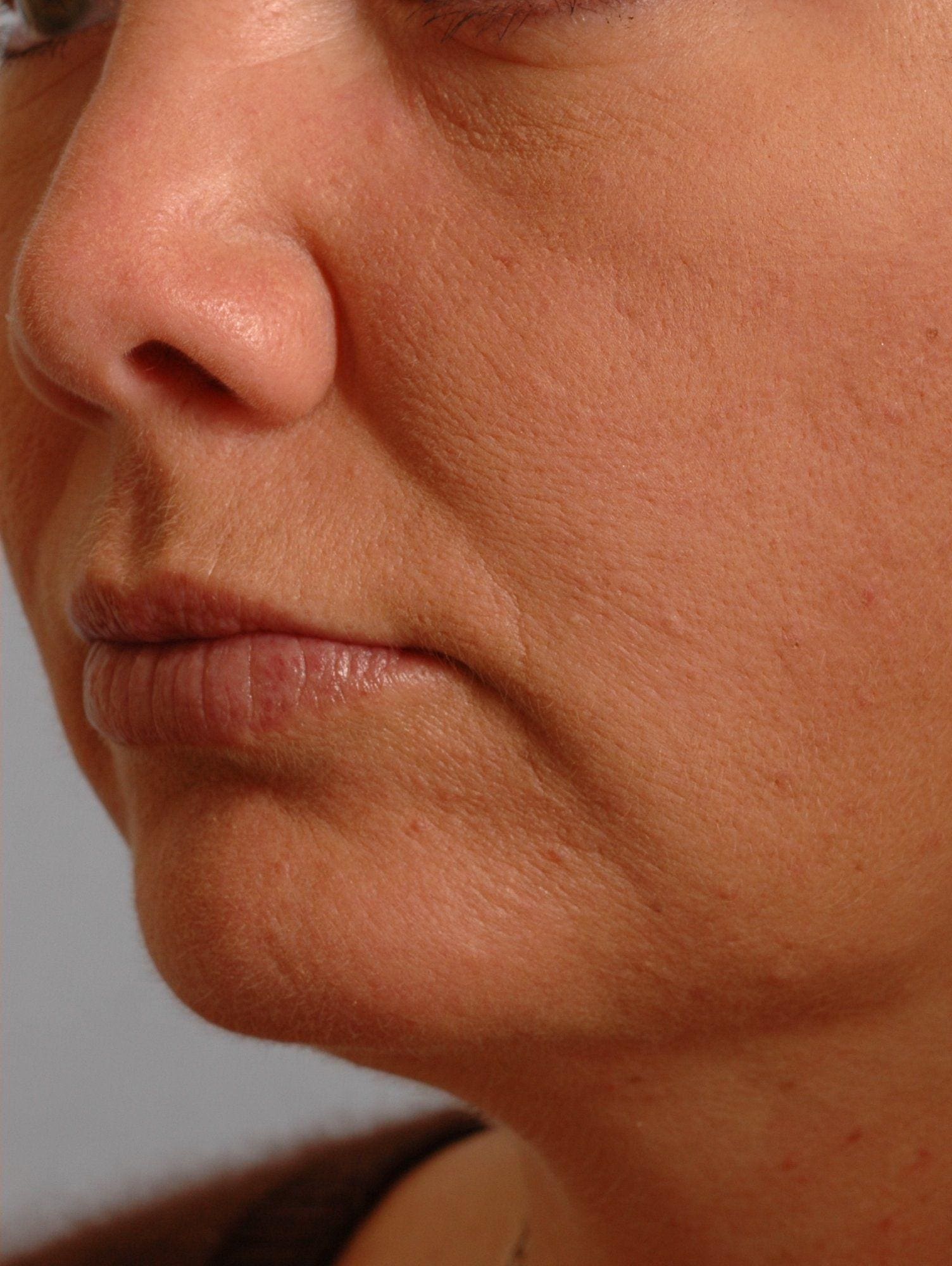 Lip Augmentation Patient Photo - Case 16279 - after view-2