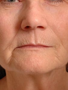 Lip Augmentation - Case 16287 - Before