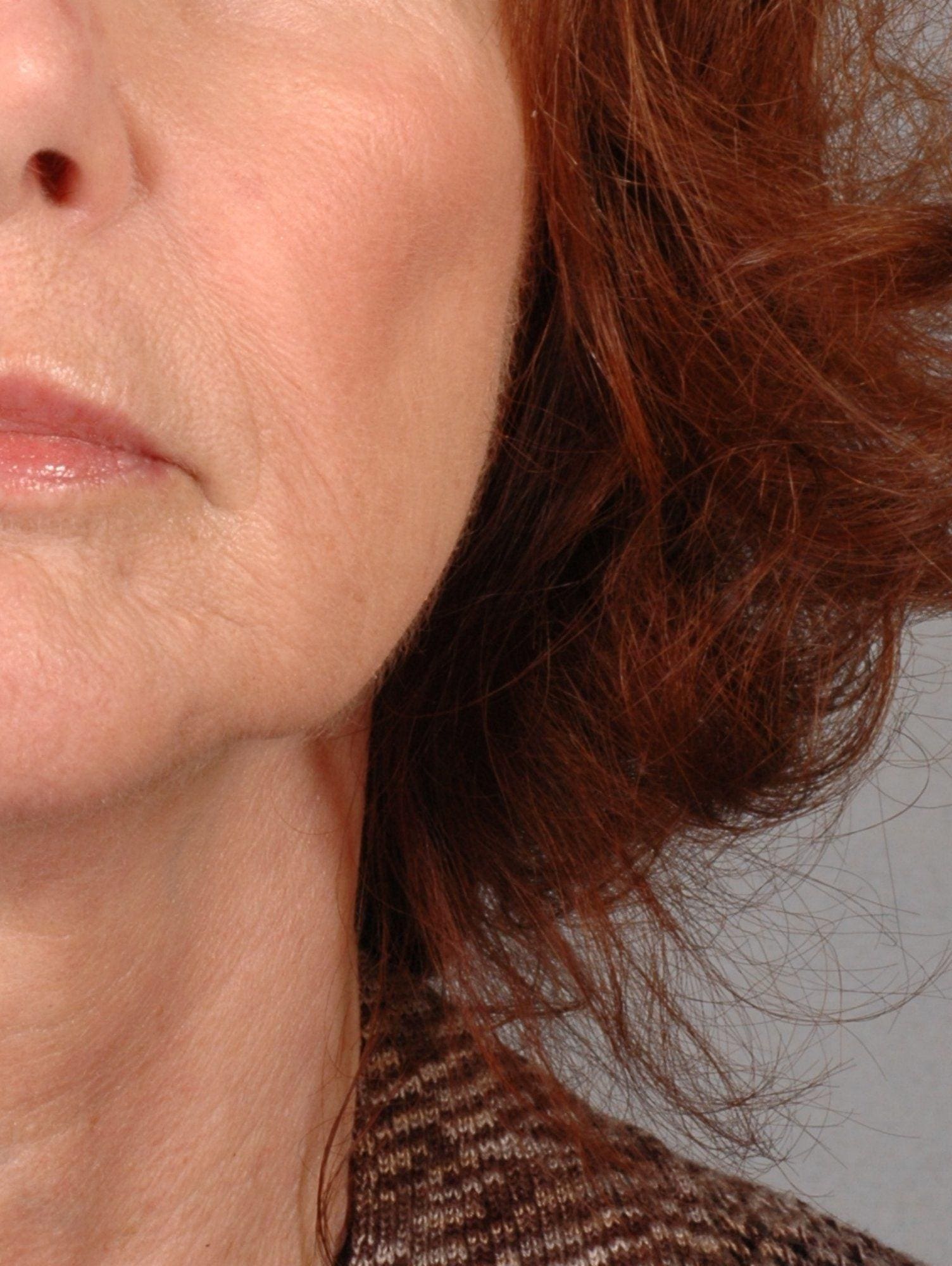Lip Augmentation Patient Photo - Case 16295 - after view-1