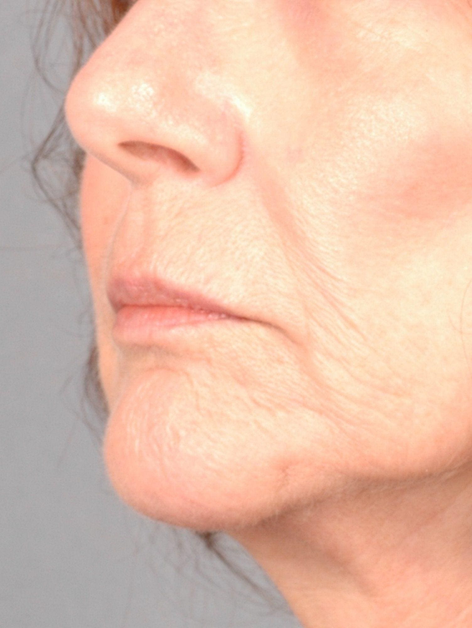 Lip Augmentation Patient Photo - Case 16295 - before view-2