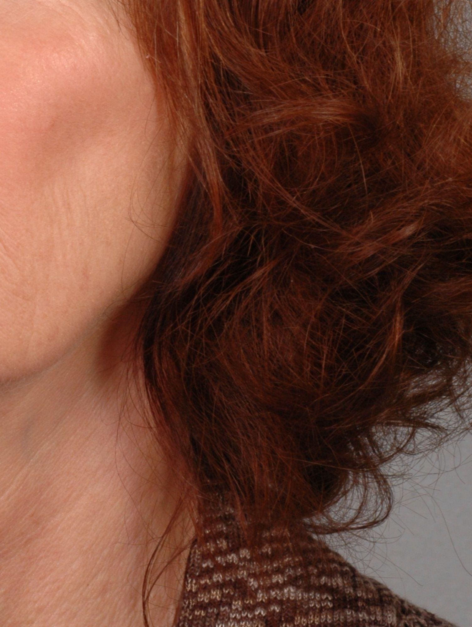 Lip Augmentation Patient Photo - Case 16295 - after view-3