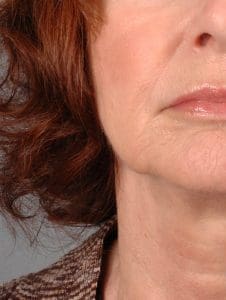 Lip Augmentation - Case 16295 - After