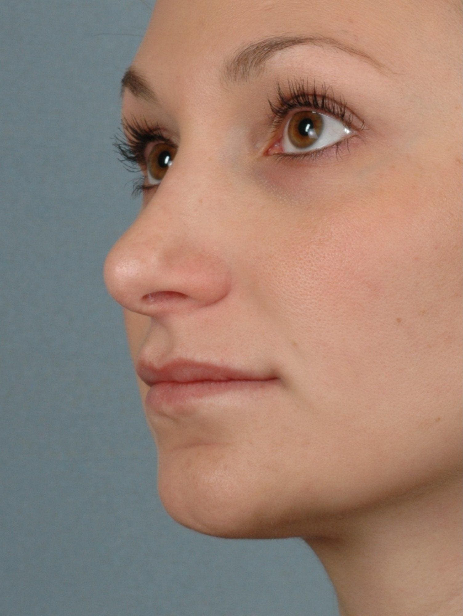 Lip Augmentation Patient Photo - Case 16304 - before view-1