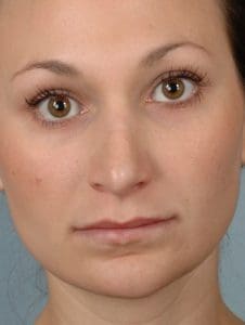 Lip Augmentation - Case 16304 - Before