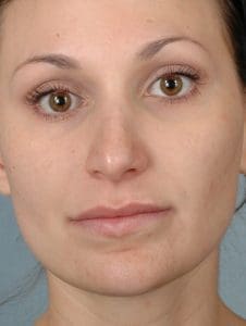 Lip Augmentation - Case 16304 - After