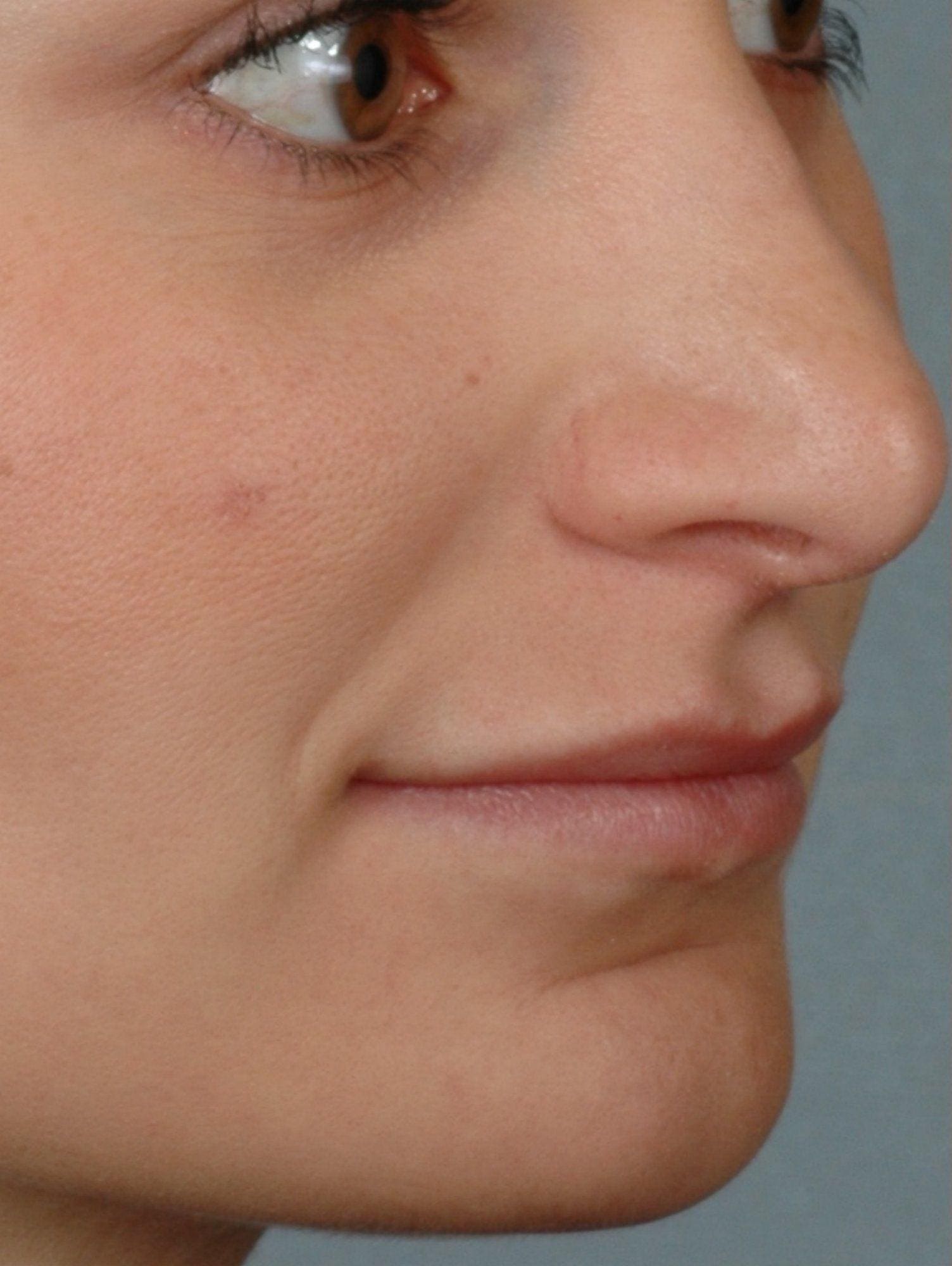 Lip Augmentation Patient Photo - Case 16304 - before view-2