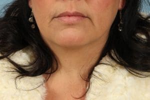 Lip Augmentation - Case 16313 - Before