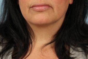 Lip Augmentation - Case 16313 - After