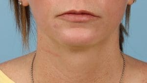 Lip Augmentation - Case 16319 - After